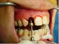 /album/galeria-de-fotos-carga-imediata-apos-exodontia-atraumatica-/carga-imediata-com-exodontia-atraumatica10-jpg/